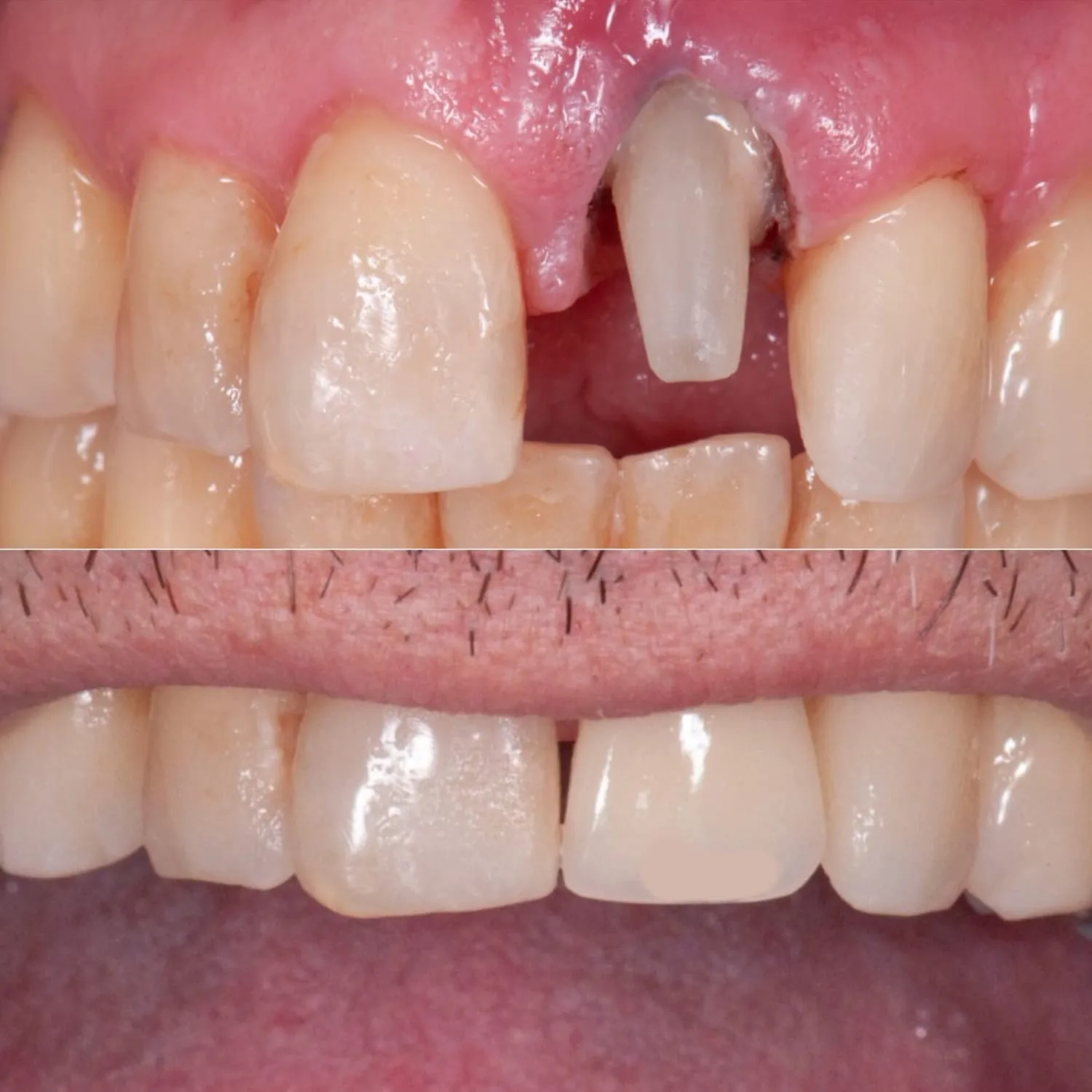 Resultado Clareamento